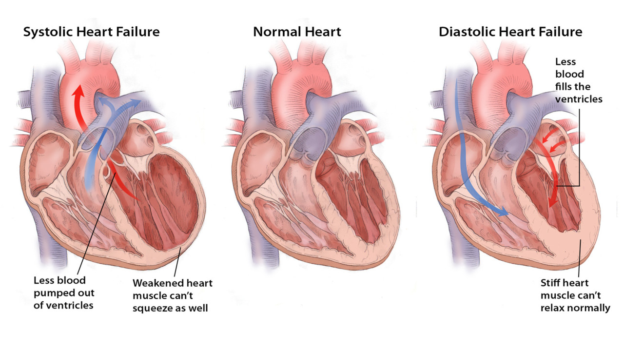 Преимущественное поражение сердца без застойной сердечной. Острая сердечная недостаточность систолическая. Осложнения митральных пороков сердца. Сердце при сердечной недостаточности. Сердце при хроническая сердечная недостаточность.