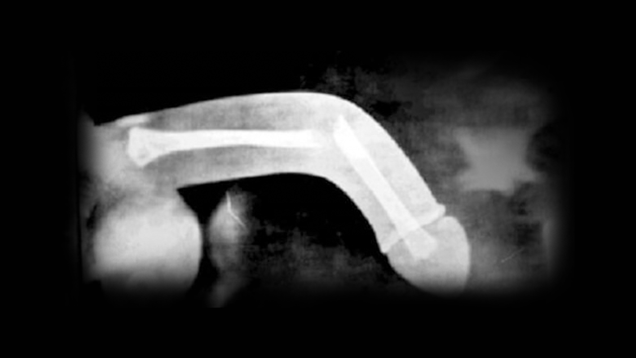 penile fracture x-ray
