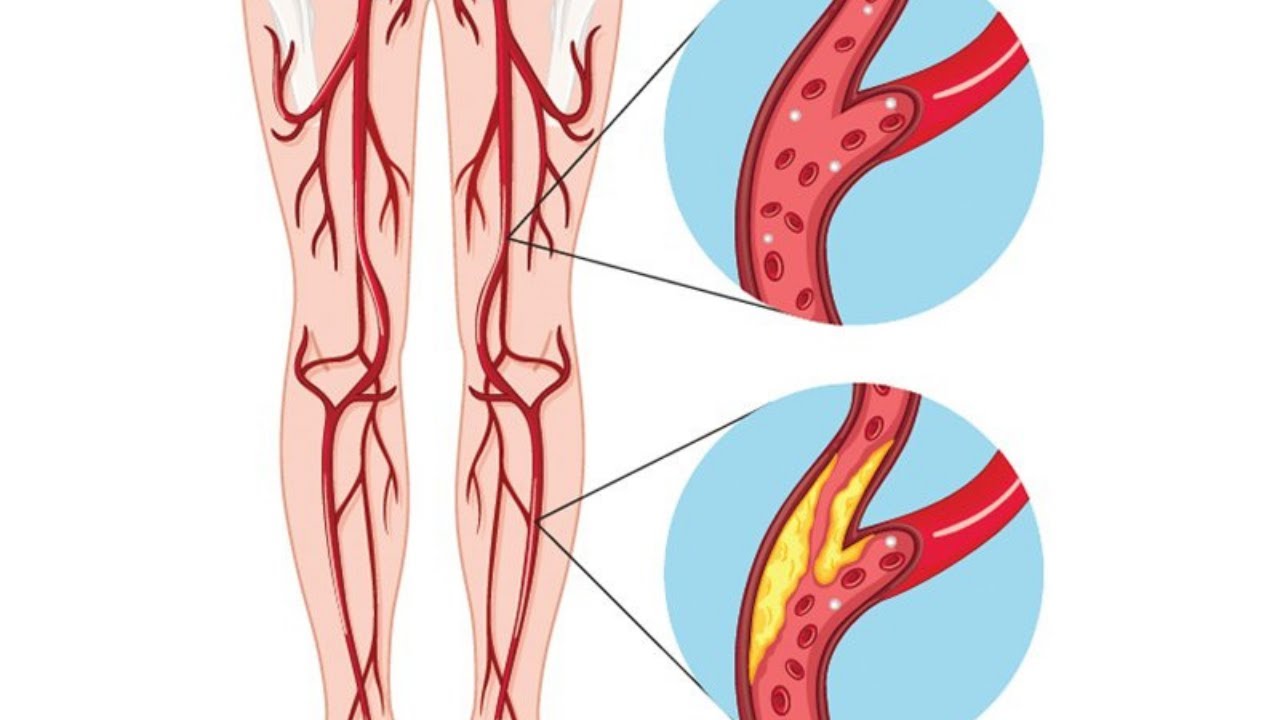 Periferik arter hastalığı