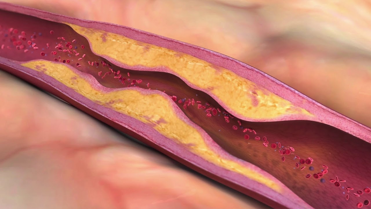 triglyceride