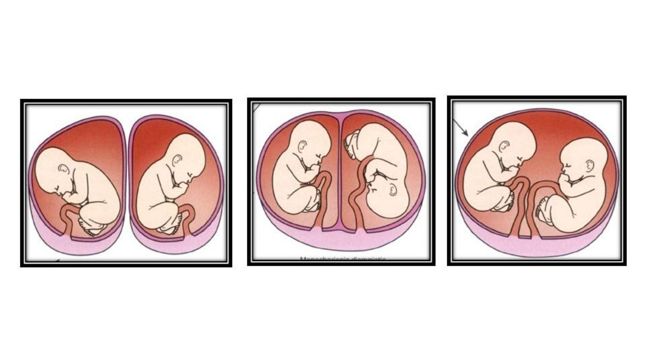 Identical Twins May Share the Same Placenta