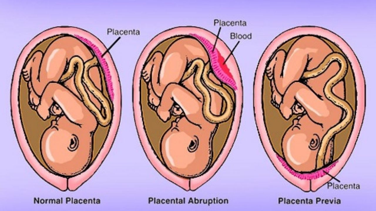 Placenta Previa