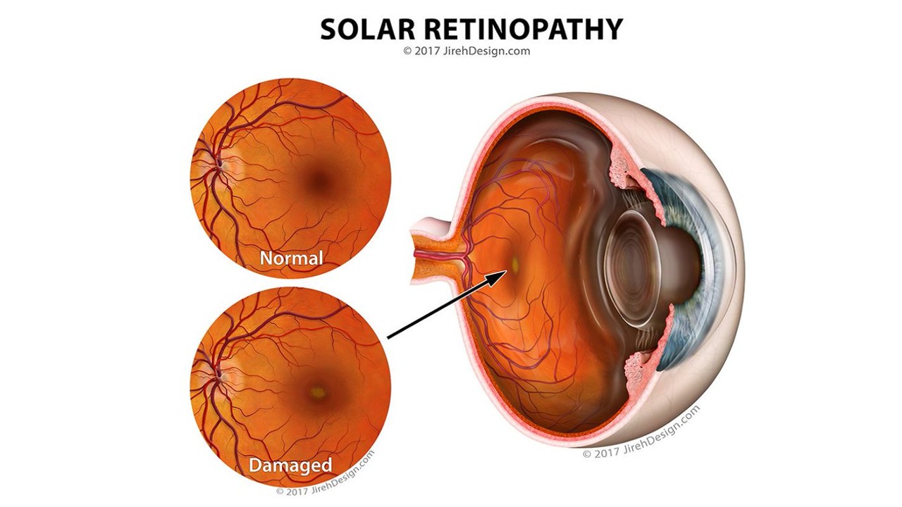 solar retinopathy disease