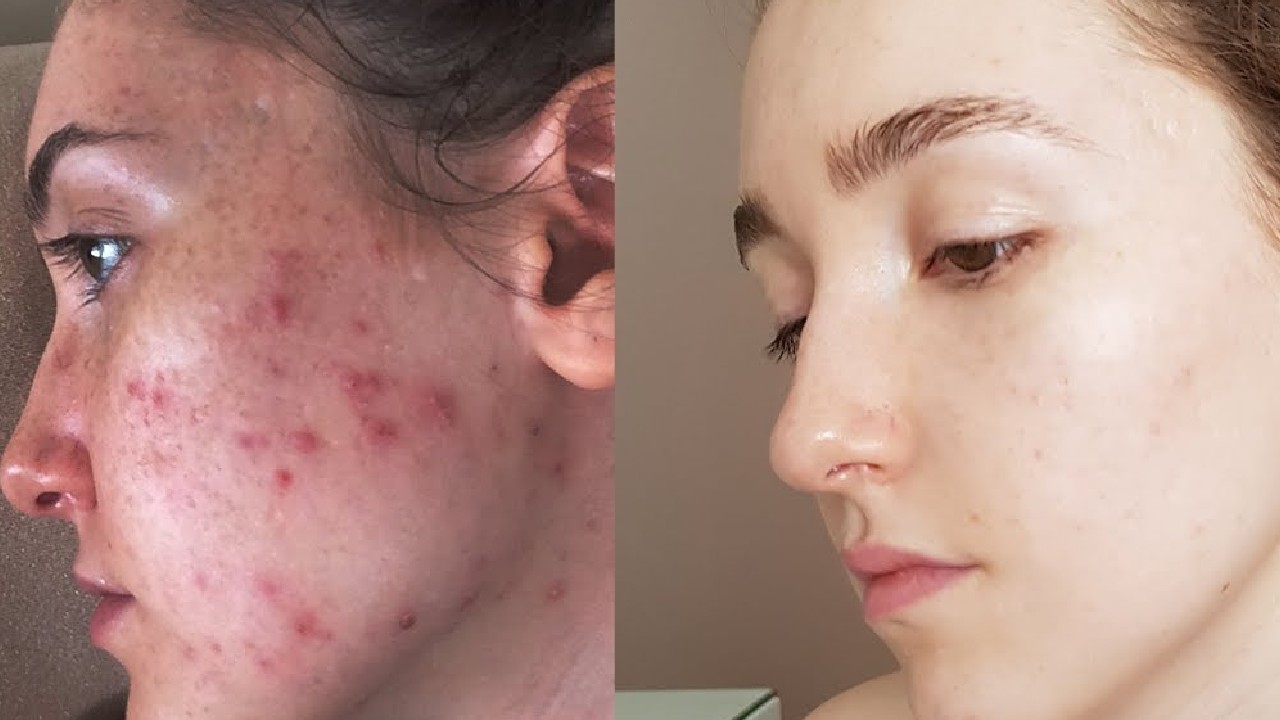 retinoids and acne treatment before and after image