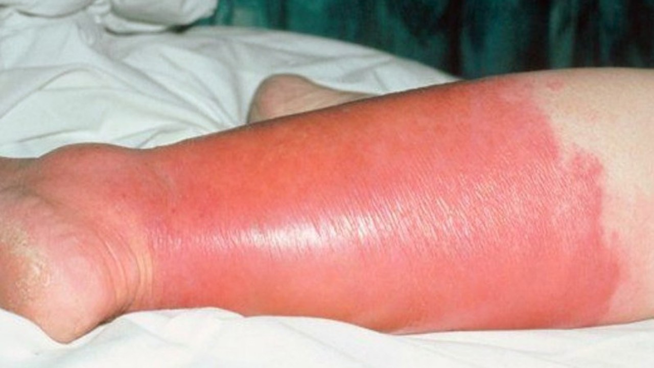 a foot affected by erysipelas