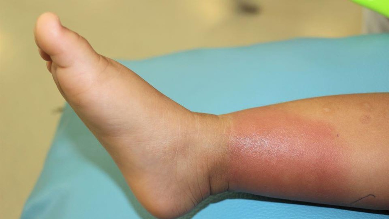 foot affected by bacteria that causes erysipelas