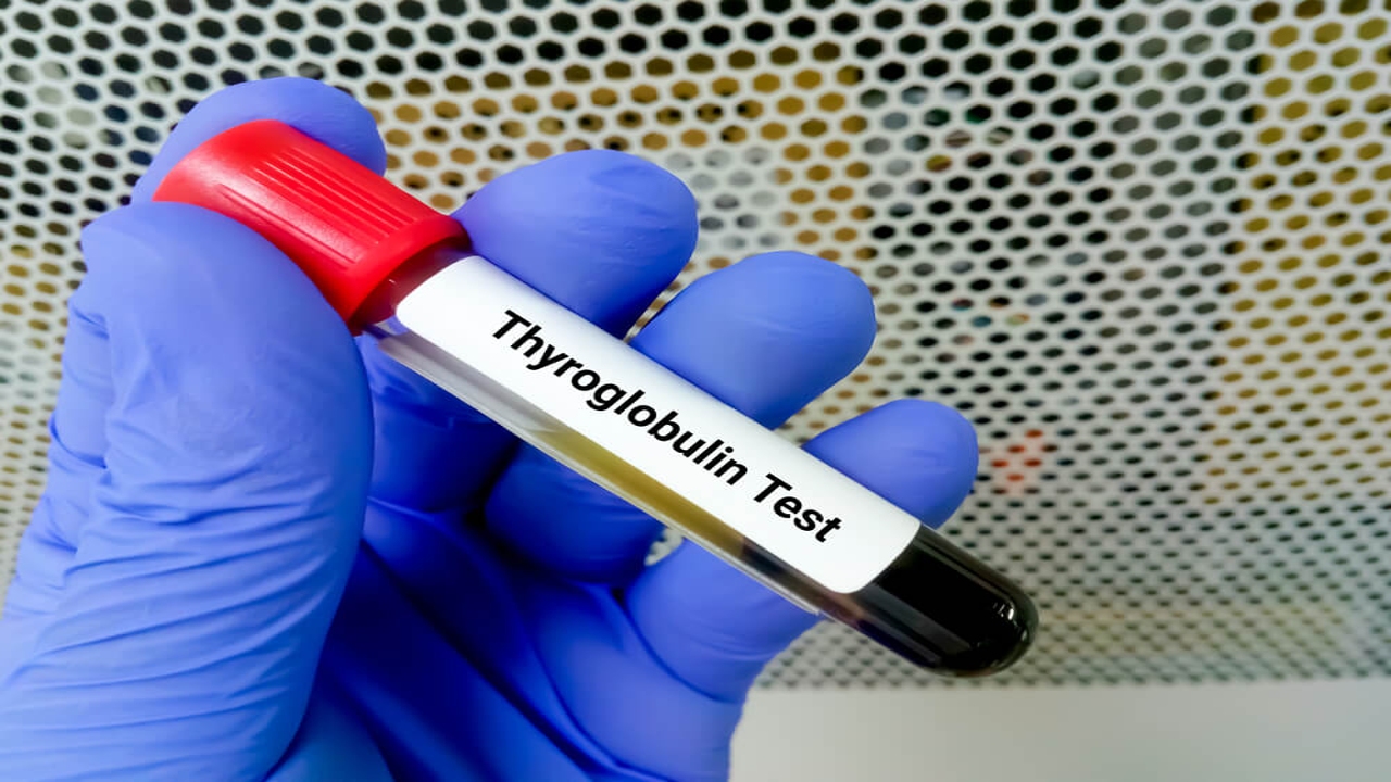 What does anti thyroglobulin antibody do?