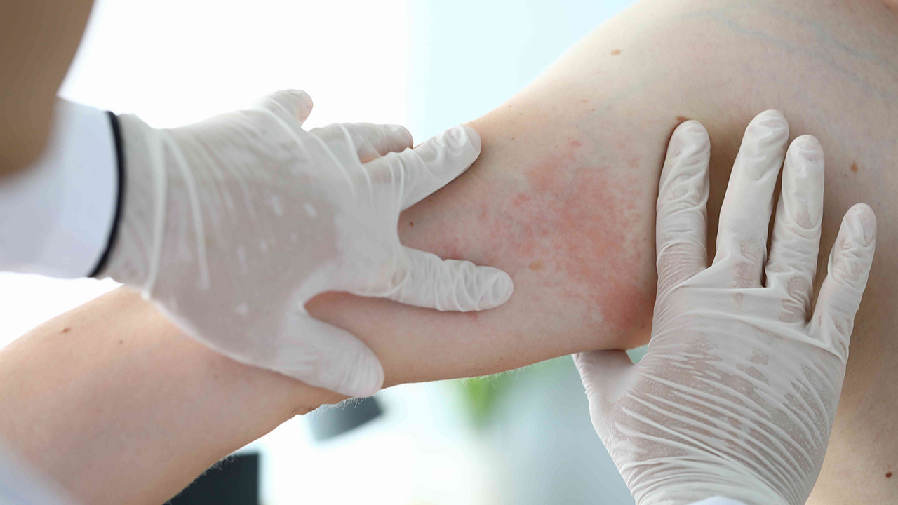 atopic dermatitis, eczema