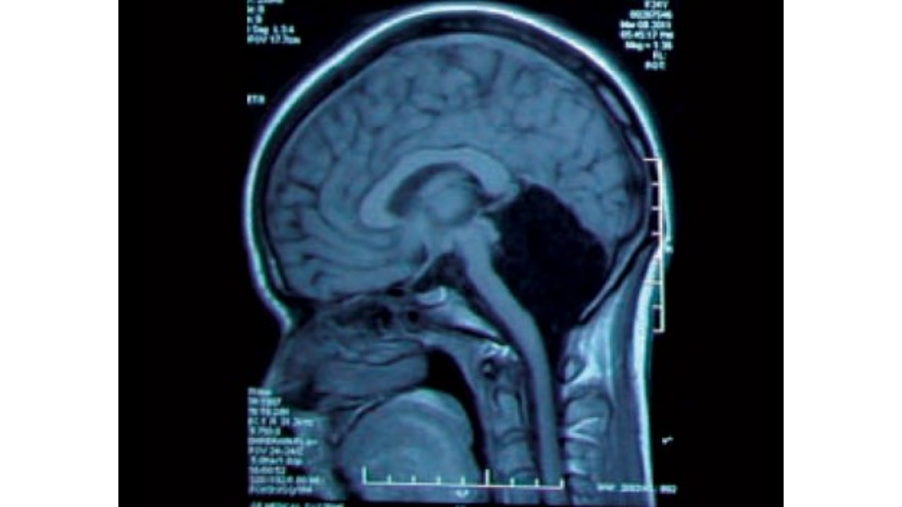 Çinli kadının beyin tomografisi