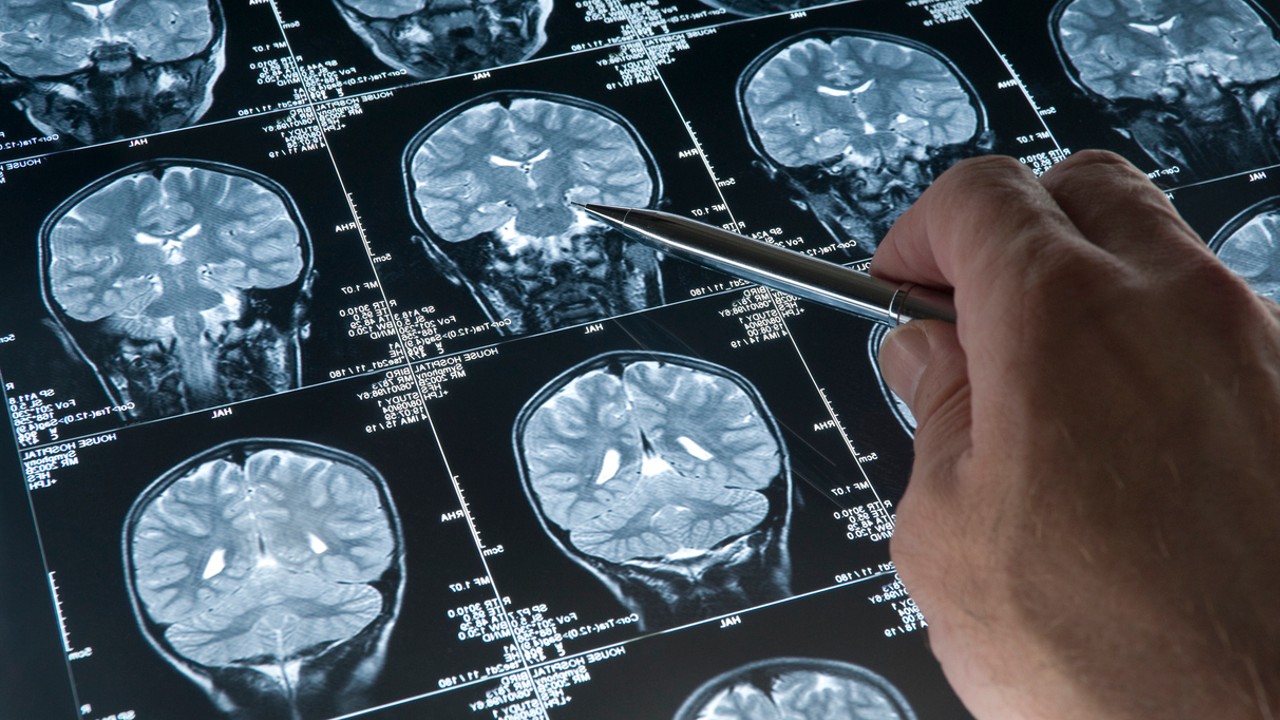 Yapay Zeka %90'lık Doğruluk Payıyla Alzheimer'ı Tespit Etti