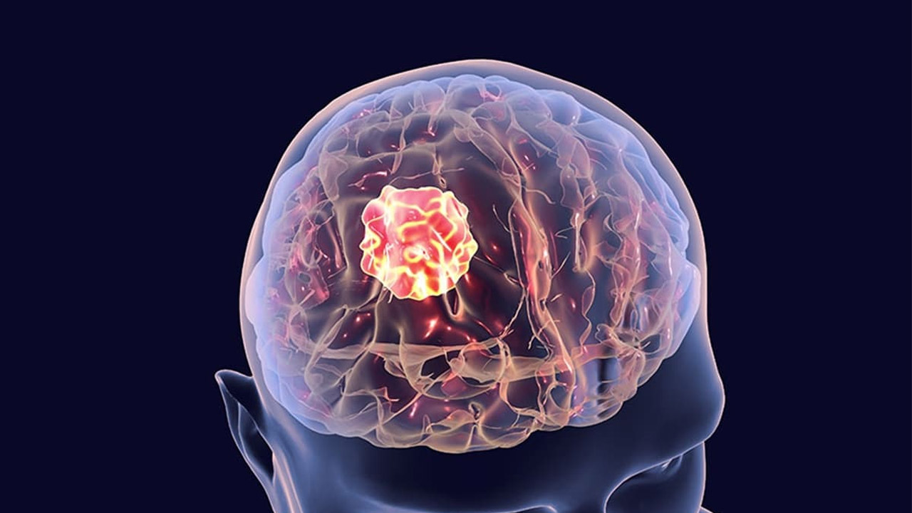 Bir doktor görünüşten beyin tümörünü tespit etti