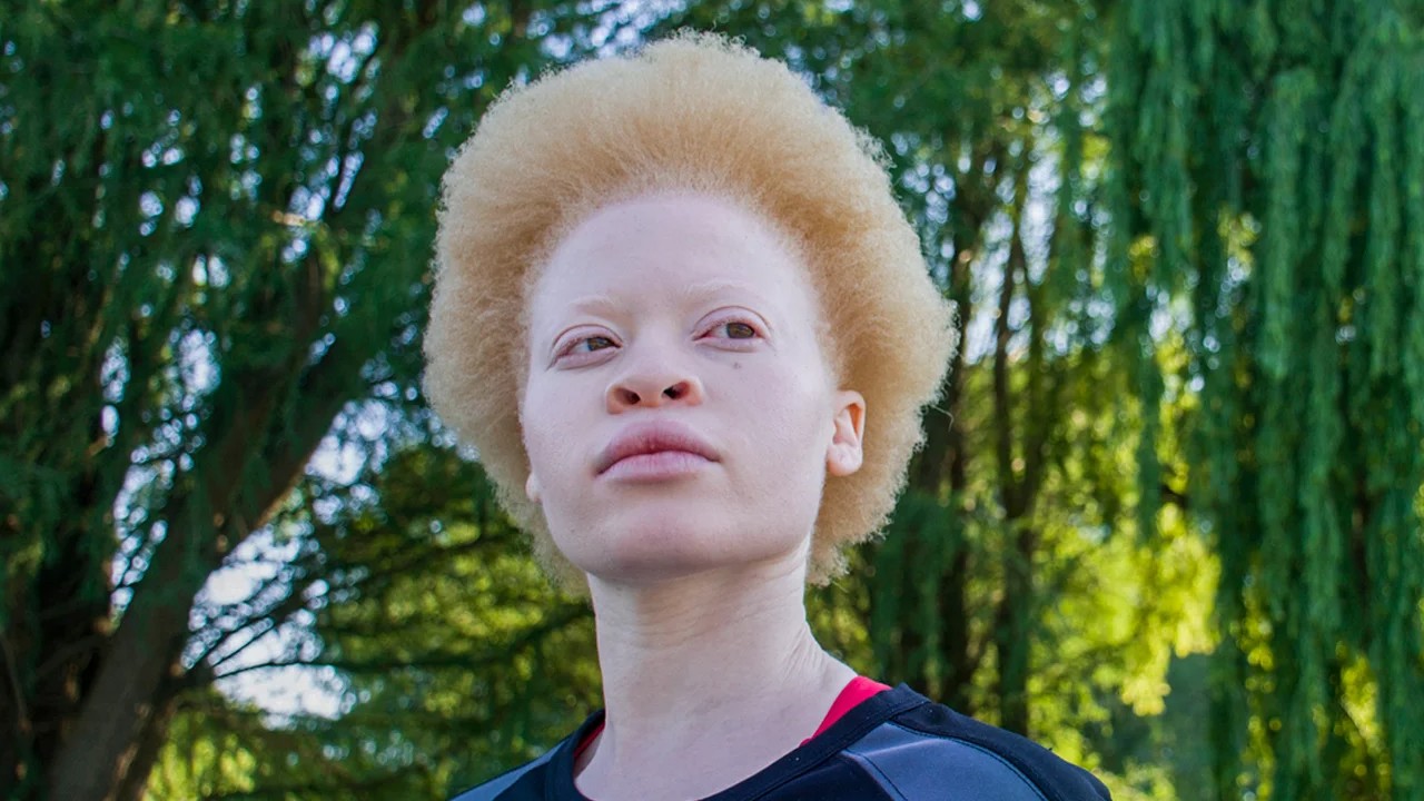albino hastalığına sahip bir kişi