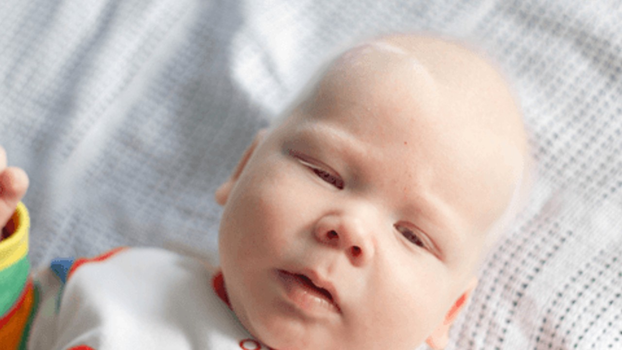 albino hastası bir bebek