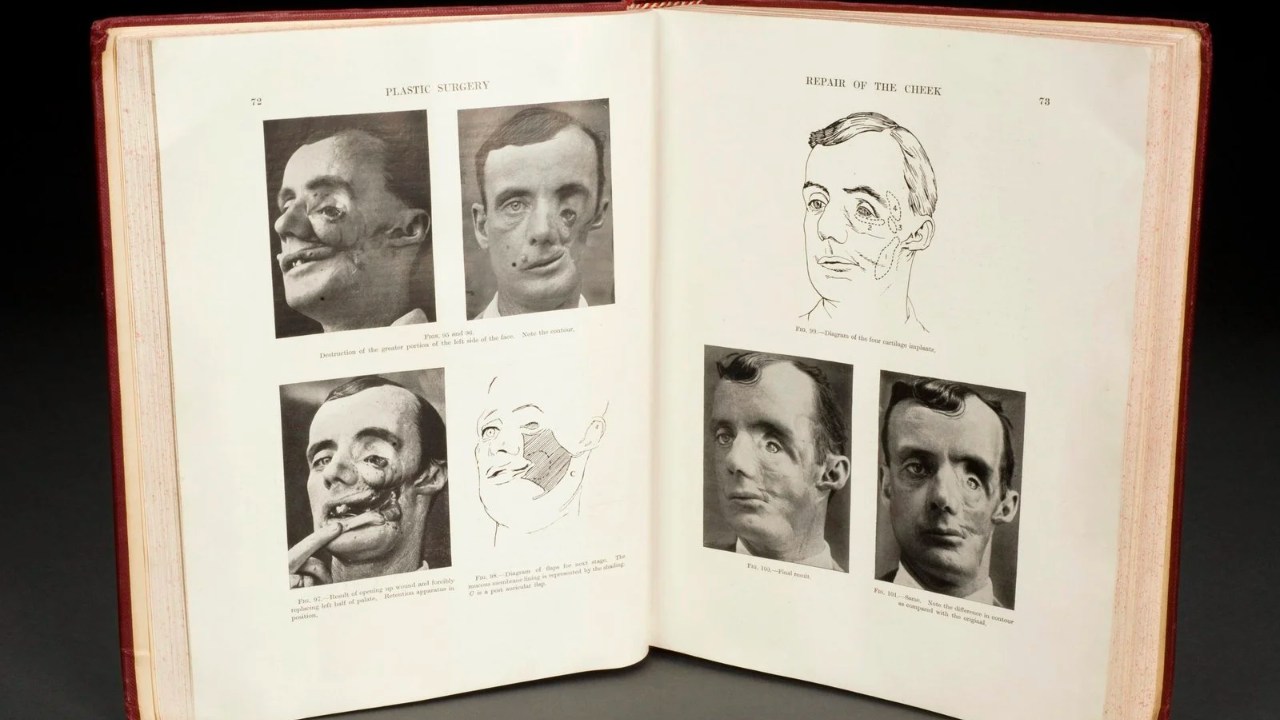 Pages from Harold Gillies' book