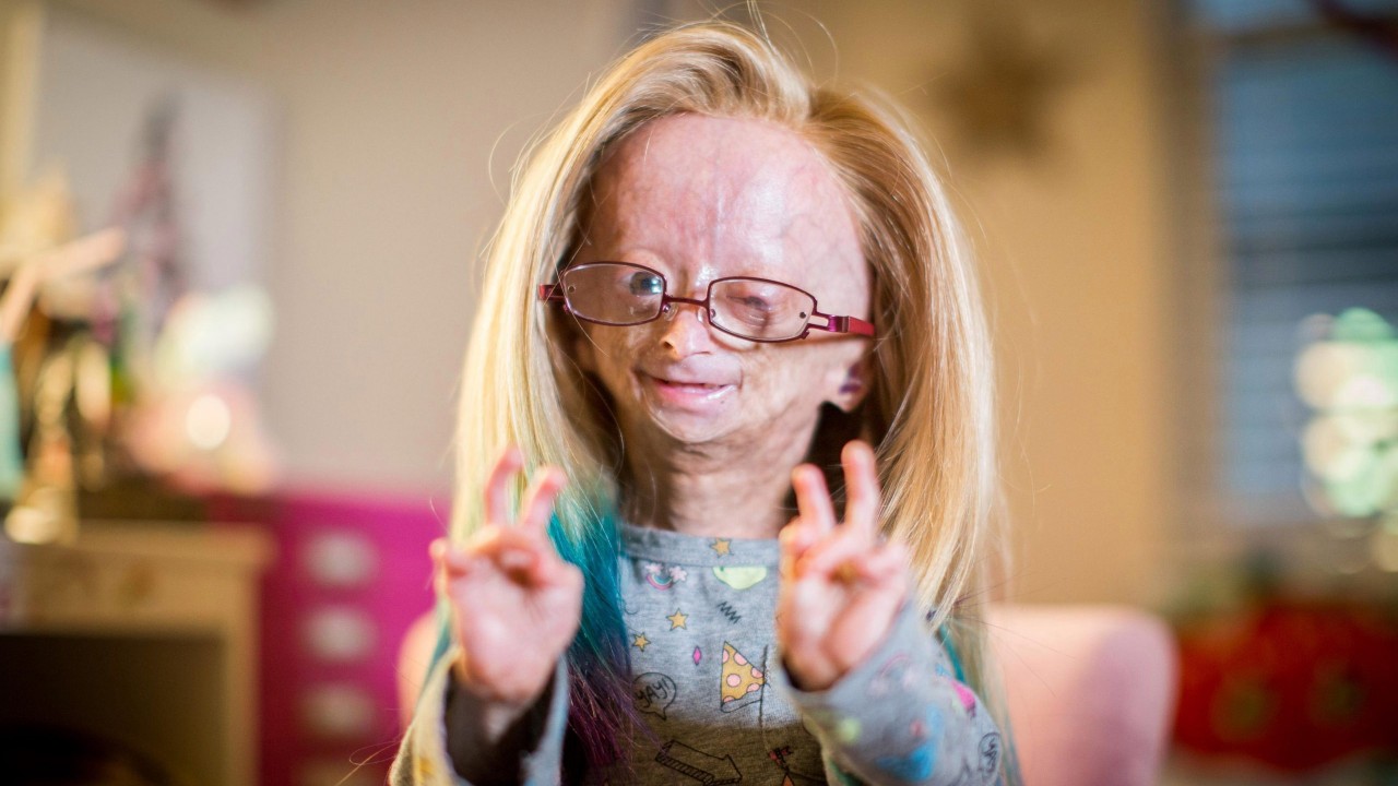 Çocukken Yaşlı Görünmeye Sebep Olan İlginç Sendrom: Progeria (Türkiye’de de Örnekleri Var!)