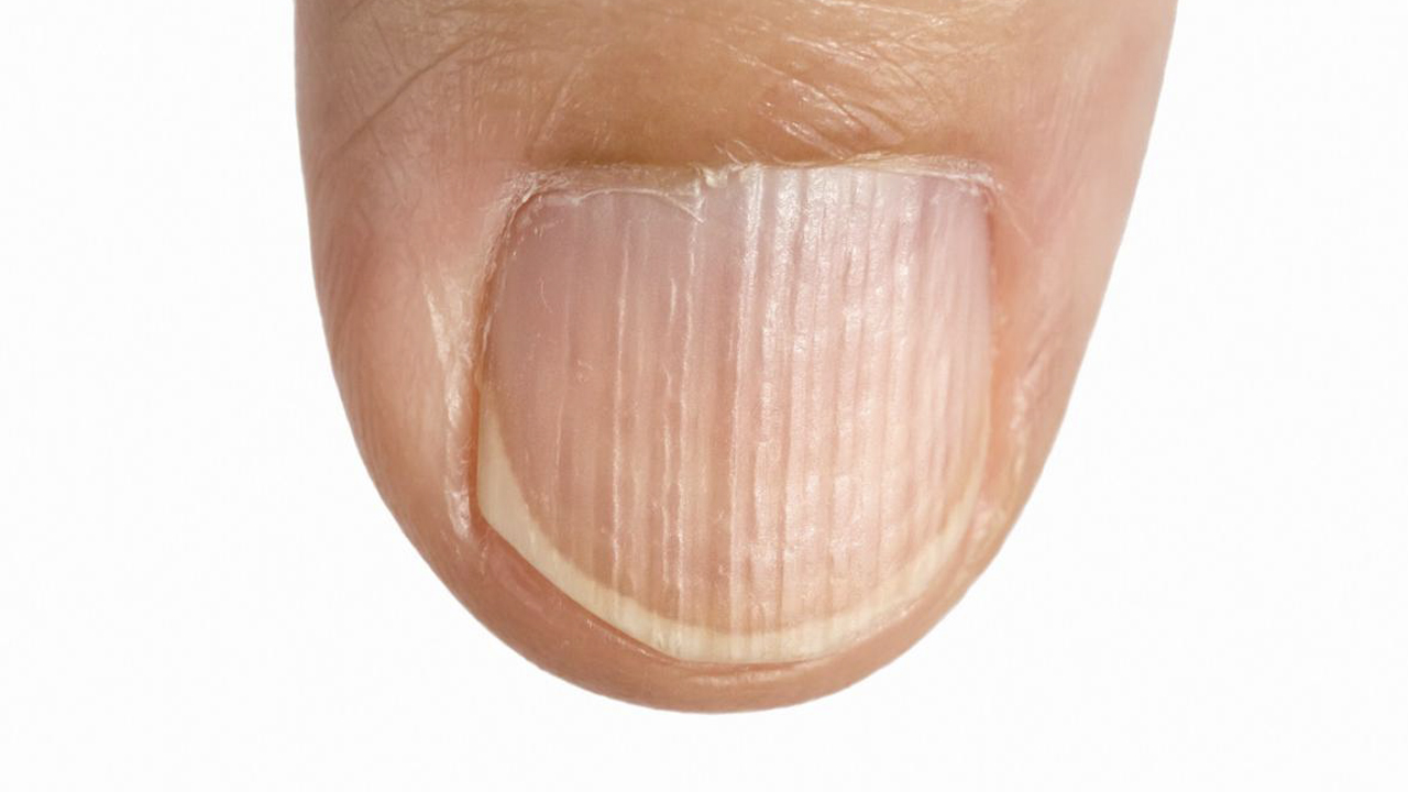 What causes protrusion on the nail?