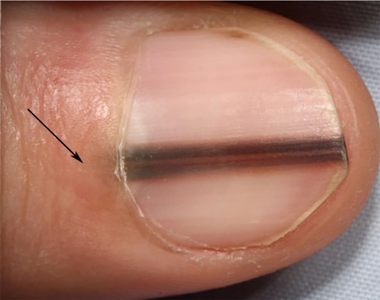 Why are there black lines on nails?